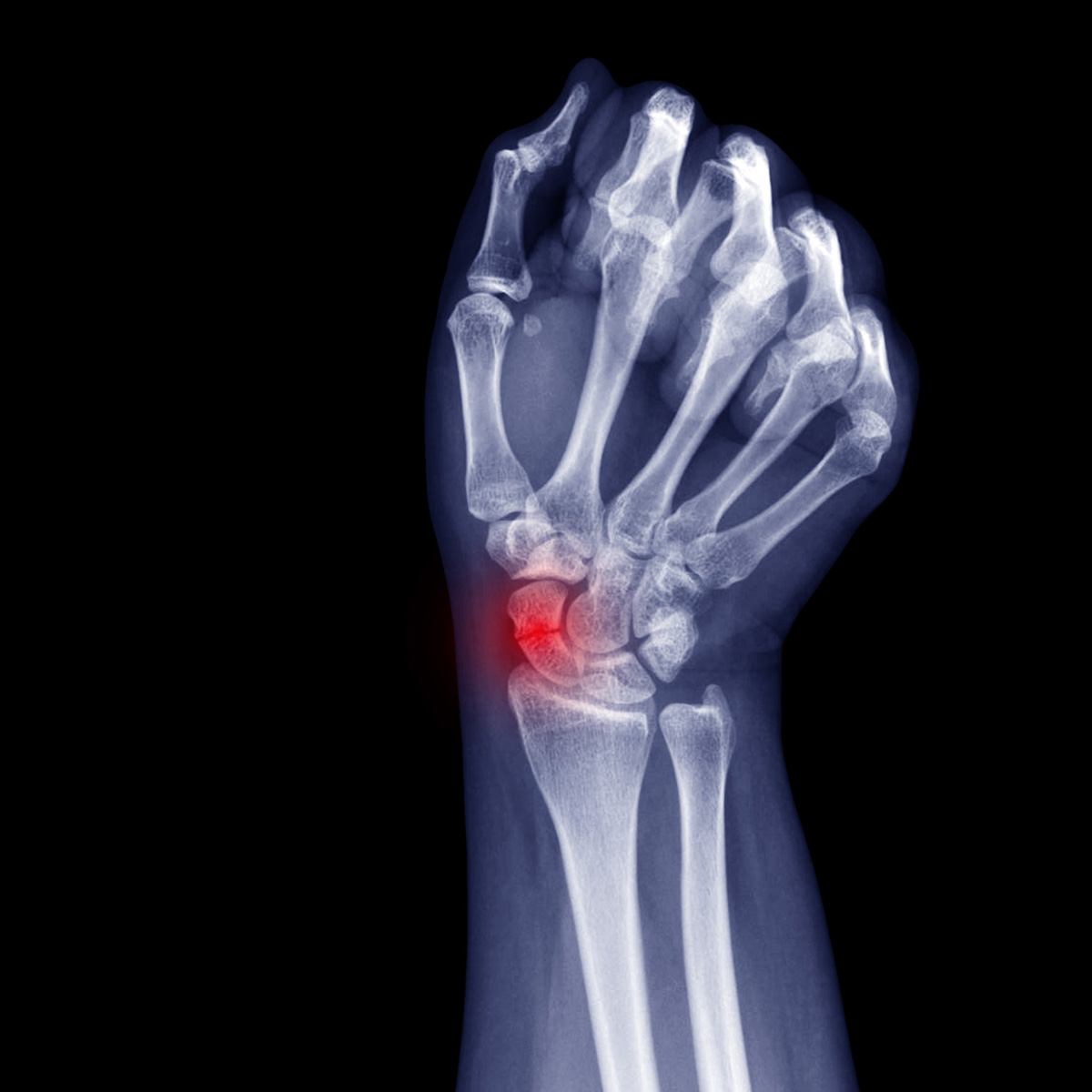 Traumatologia della mano - fratture
