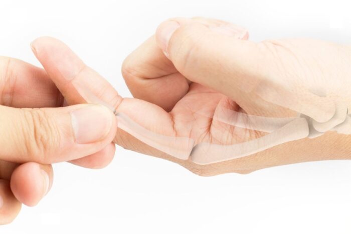 distacco parcellare falange