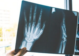 Come riconoscere microfrattura mano
