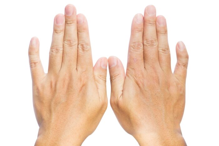 Dita della mano storte