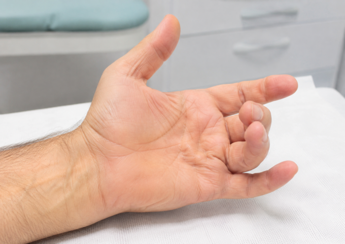 Malattia di Dupuytren con dita piegate verso il palmo e difficoltà nel lavoro manuale